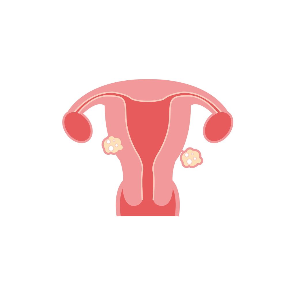 hysterectomy: fibroids